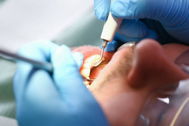Best Emergency Treatment for Dental Infections or Abscesses in Rowland Heights, CA